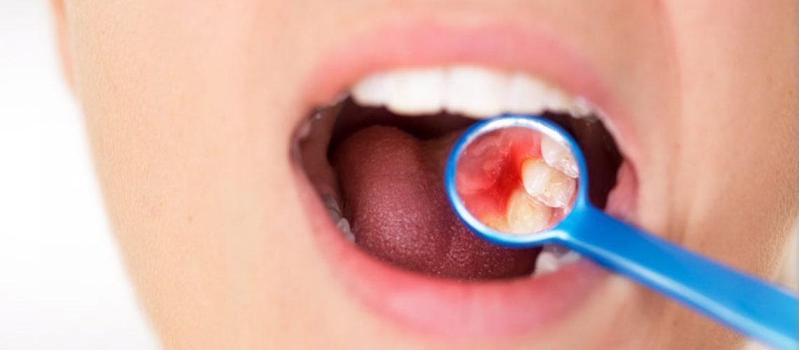 Dental Patient In Need Of Periodontal Treatment