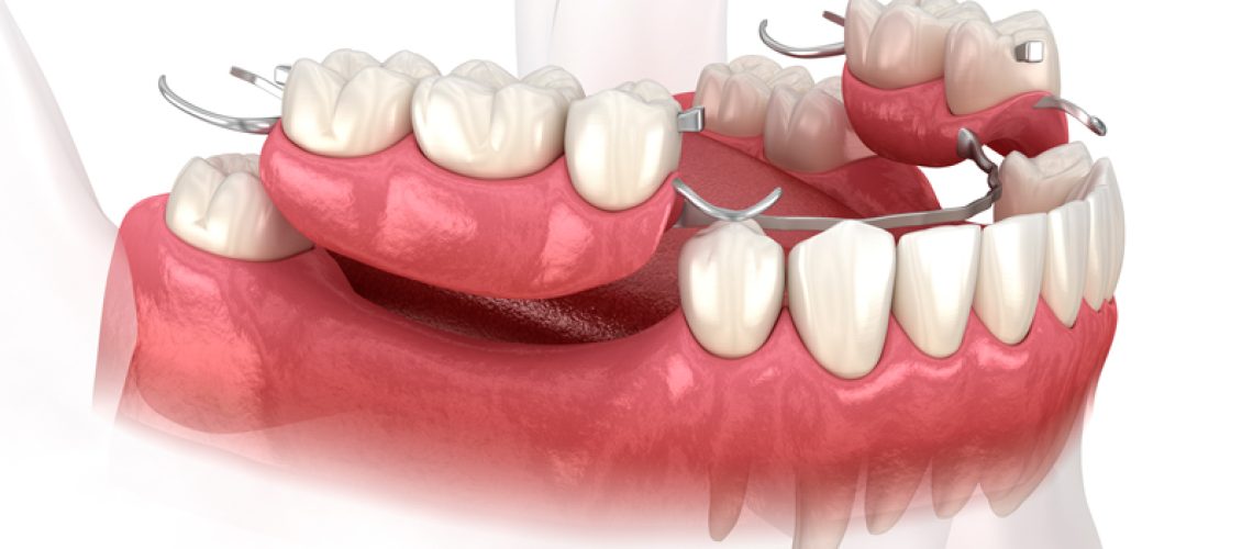 Close-up 3d image of a dental implant