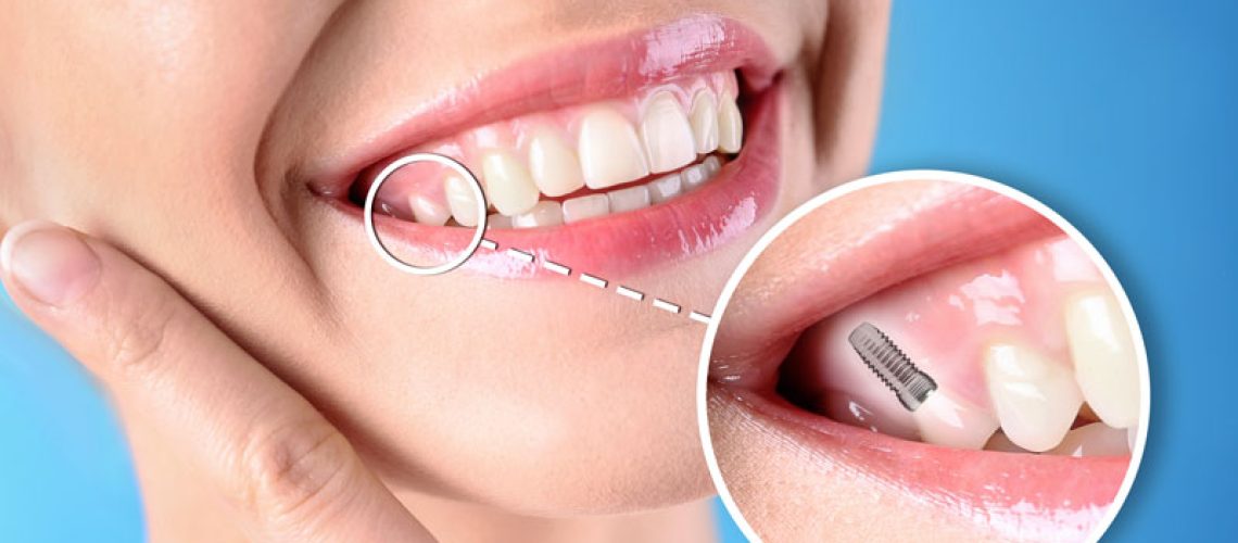 dentalimplants1-3-24