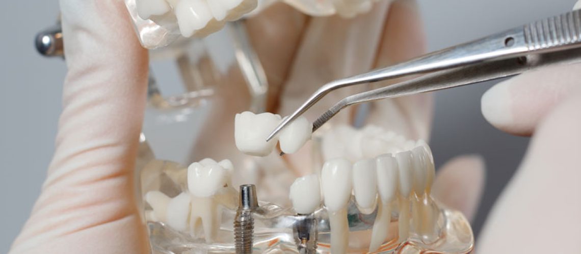 dentalimplants2-3-24