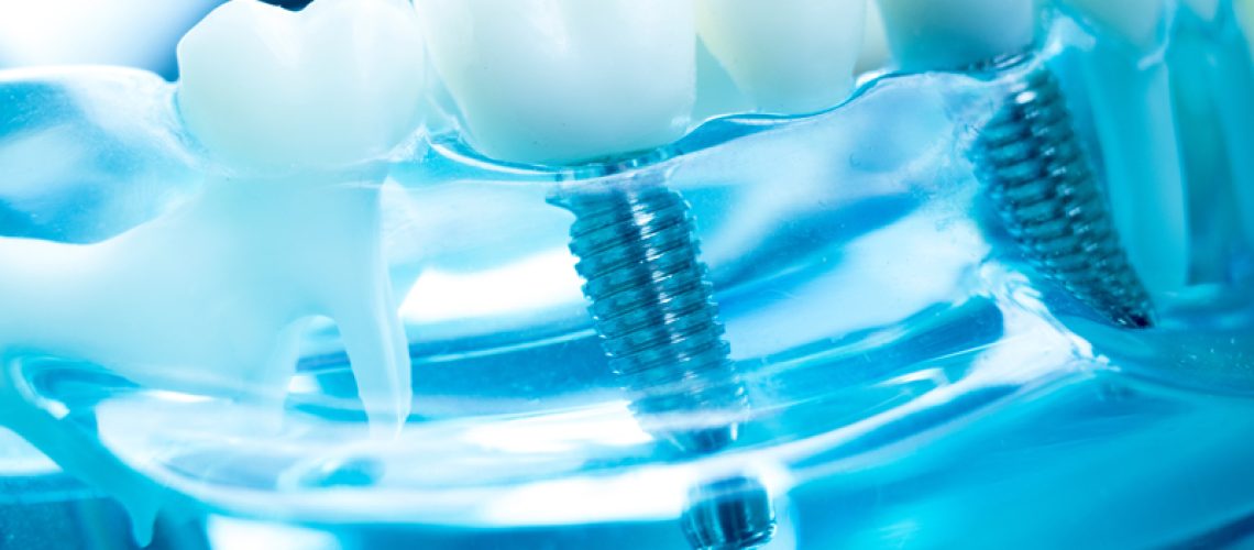 Close-up 3d image of a dental implant
