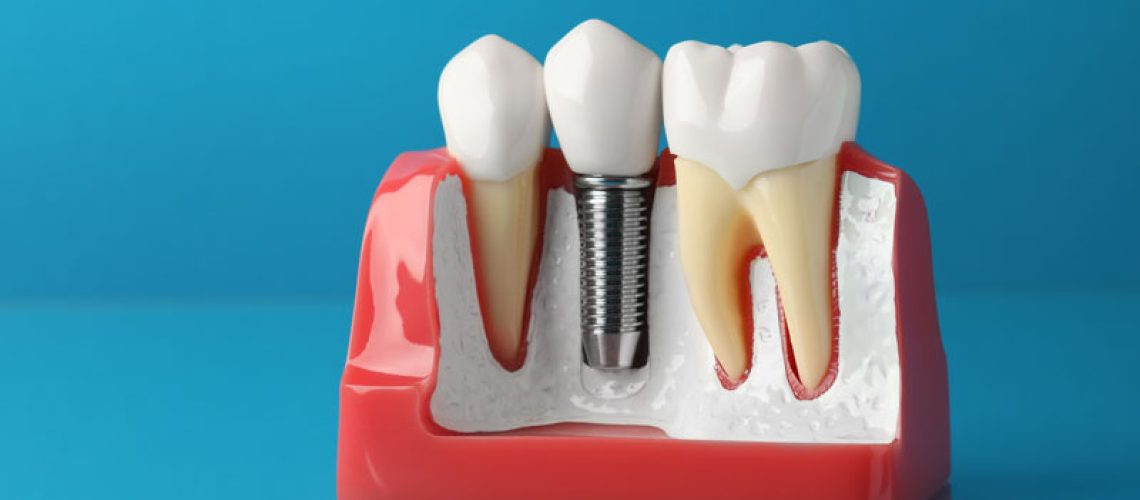 dentalimplants3-3-24
