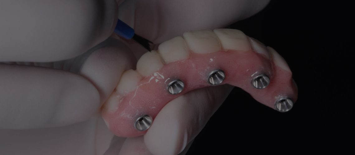 full arch dental implants model