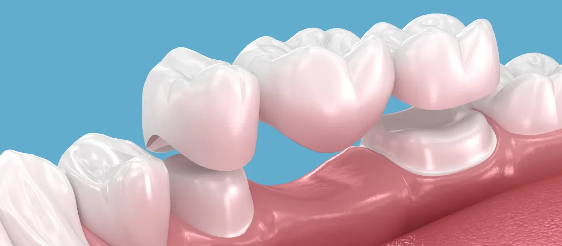 3D illustration of a dental bridge spanning a missing tooth, showing how the restoration connects to surrounding teeth, one option patients consider when replacing a missing tooth.