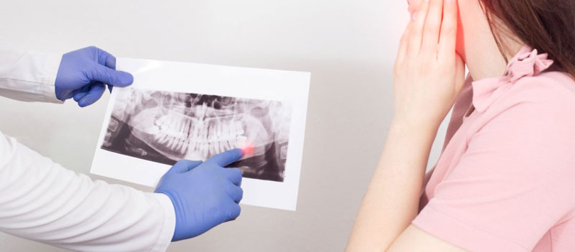 impacted-wisdom-tooth-xray-with-patient