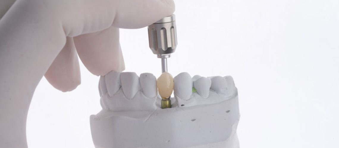 single-dental-implant-model