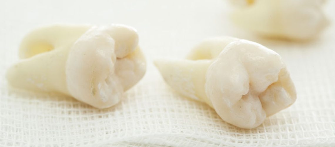 Model Of A Wisdom Tooth