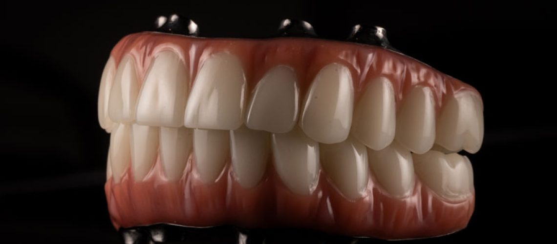 top-and-bottom-prosthesis-for-full-mouth-dental-implants
